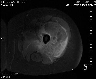 Tumor Surgery : Bone Cancer Tumors : Sarcoma Surgeon : NYC